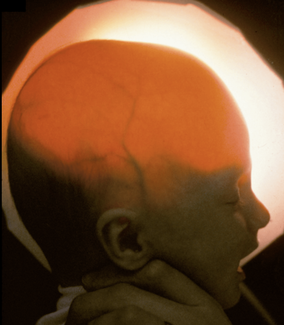light passing through an infant's skull